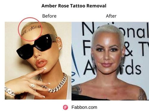 Amber-Rose-Tattoo-Removal 