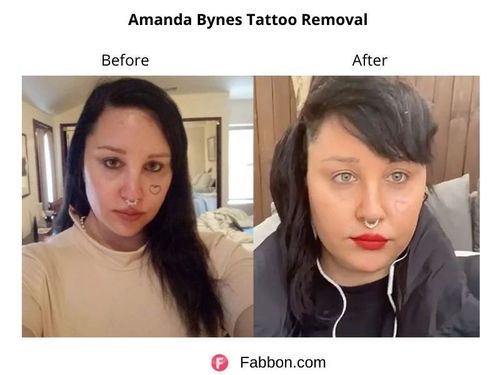 Amanda-Bynes-Tattoo-Removal 