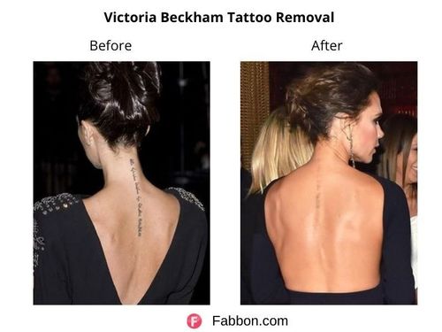 Victoria-beckham-Tattoo-Removal 