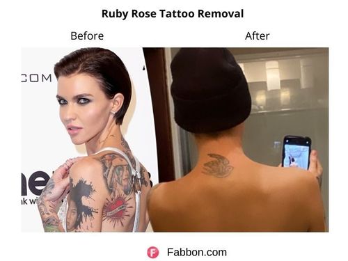 Ruby-Rose-Tattoo-Removal 