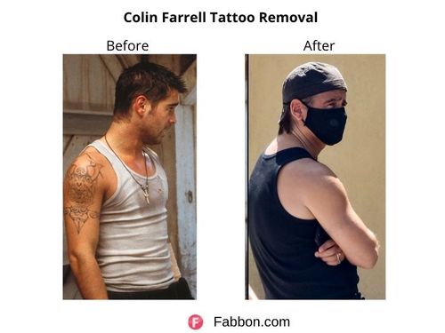 Colin-Farrell-Tattoo-Removal 