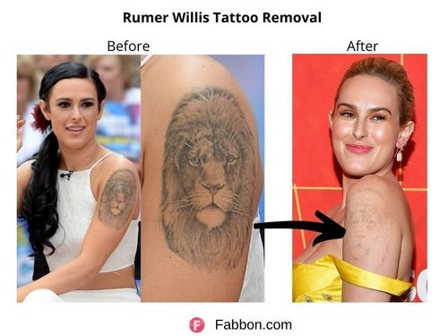 More Awesome results with our Cutera Enlighten Tattoo Removal Laser at Well  Medical Arts. Call ***-***-**** to schedule your… | Tattoo removal, Medical  art, Tattoos