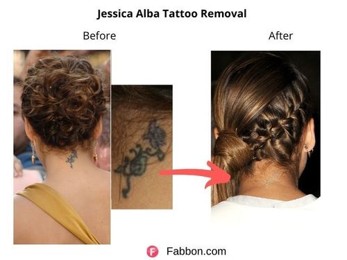 Jessica-Alba-Tattoo-Removal 