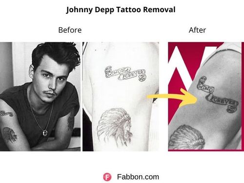Johnny-Depp-Tattoo-Removal 