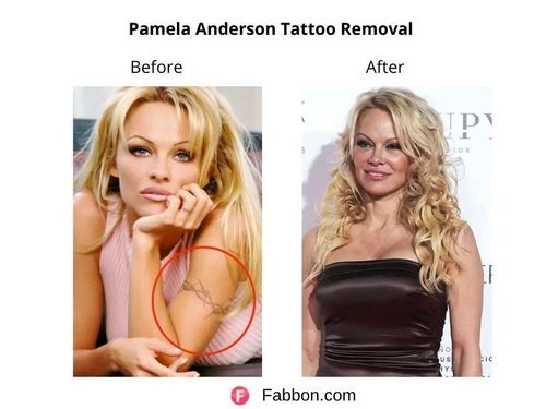 Pamela-Anderson-Tattoo-Removal 