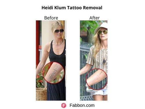 Heidi-Klum-Tattoo-Removal 