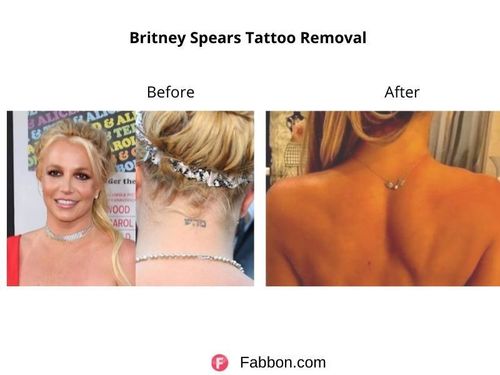 Britney-Spears-Tattoo-Removal 