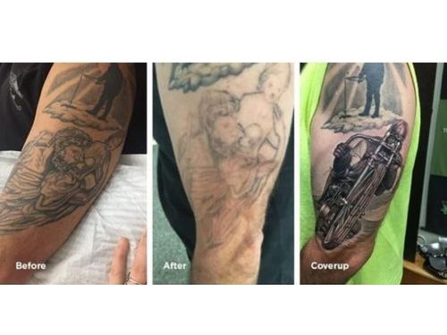 american-tattoo-removal