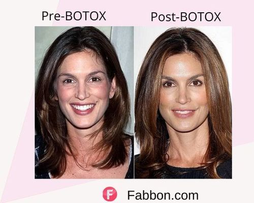 cindy crawford Before and after BOTOX