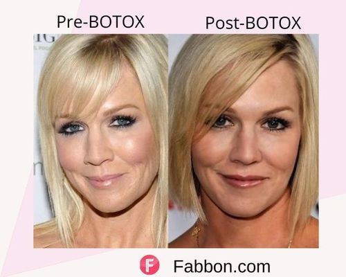 Jennie Garth Before and after BOTOX