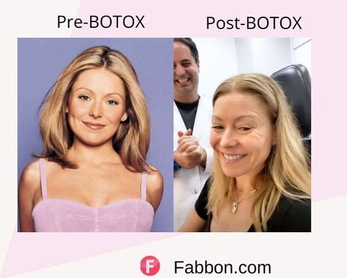 Kelly Ripa Before and after BOTOX