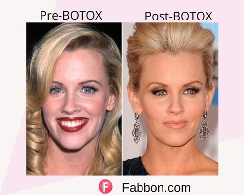 Jenny McCarthy Before and after BOTOX