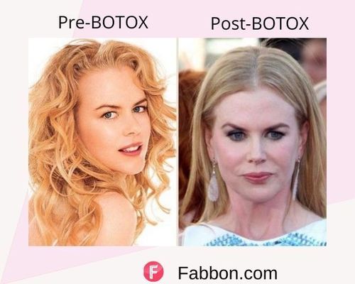 Nicole Kidman Before and after BOTOX