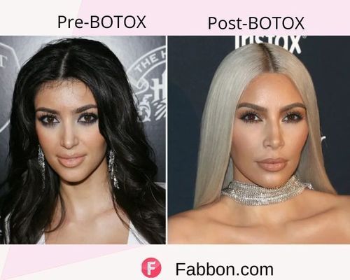 Kim K Before and after BOTOX