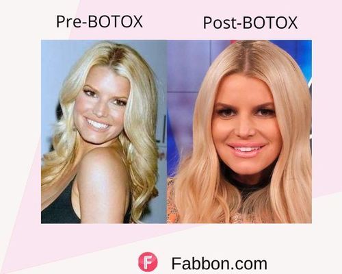 Jessica Simpson Before and after BOTOX
