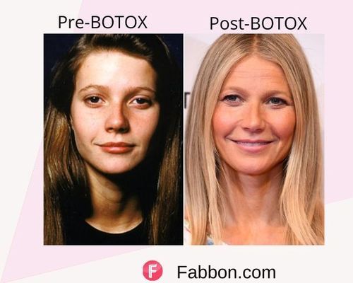 Gwyneth paltrow Before and after BOTOX