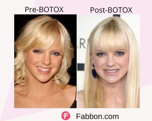 Anna Faris Before and after BOTOX