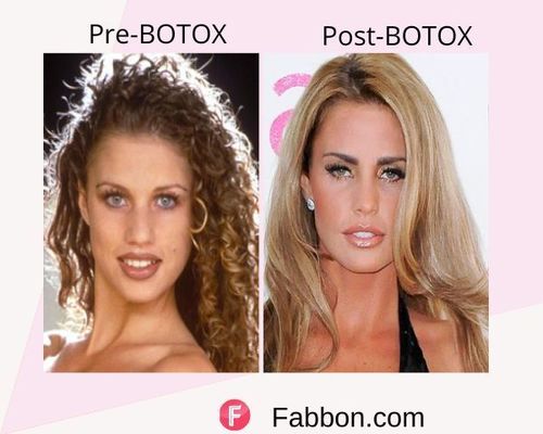 Katie Price  Before and after BOTOX