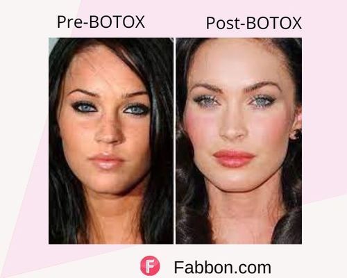 Megan Fox Before and after BOTOX