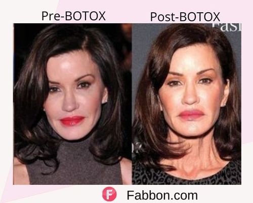 Janice Dickinson Before and after BOTOX