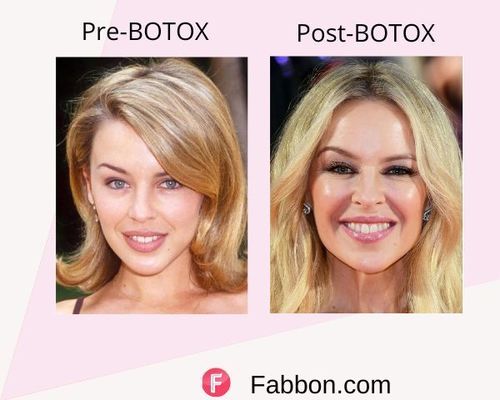 Kylie Minogue Before and after BOTOX
