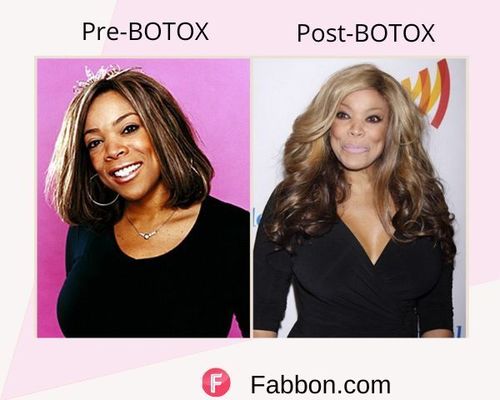 Wendy Williams Before and after BOTOX
