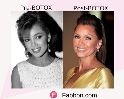 Vanessa Williams Before and after BOTOX