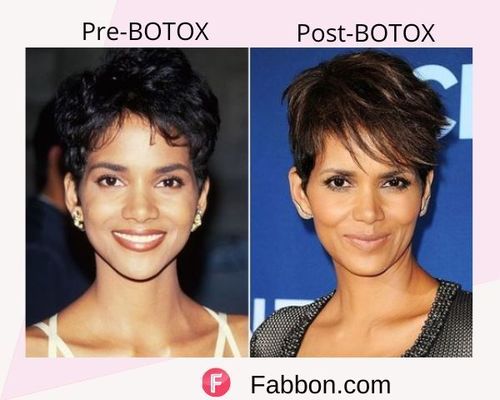 Halle Berry Before and after BOTOX