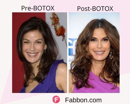 teri Hatcher Before and after BOTOX