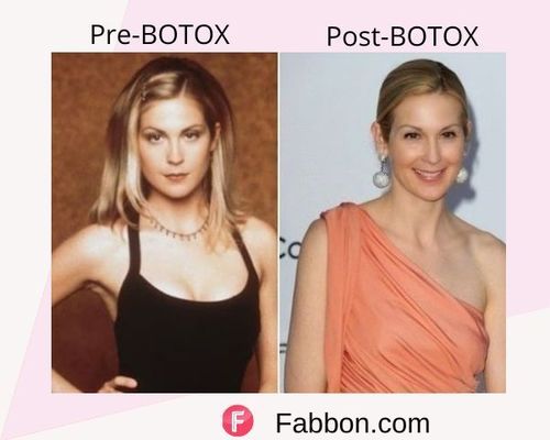 Kelly Rutherford  Before and after BOTOX