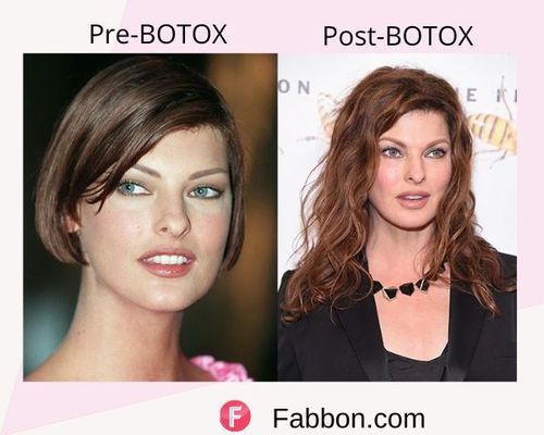 Linda Evangelista Before and after BOTOX