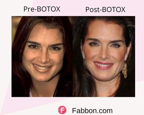 Brooke Shields Before and after BOTOX
