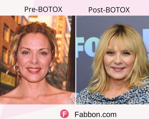 Kim Cattrall Before and after BOTOX