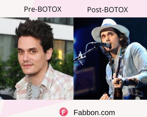 john mayer Before and after BOTOX
