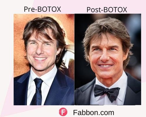 Tom Cruise Before and after BOTOX