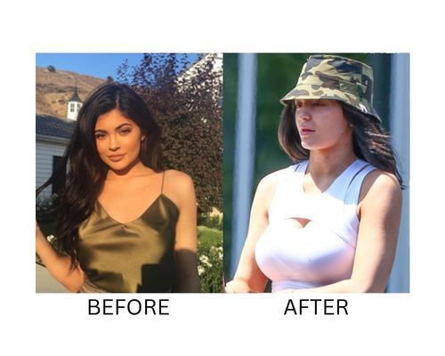 kylie-jenner-breast-augmentation