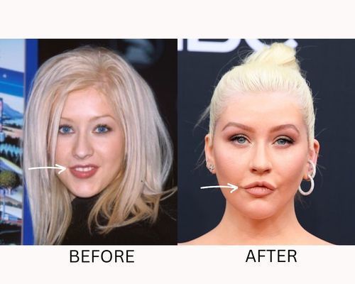 christina-aguilera-plastic-surgery-lip-fillers