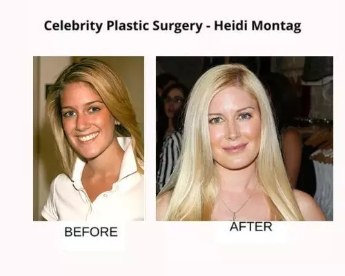 heidi-montag-plastic-surgery