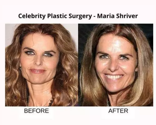 Celebrity-plastic-surgery-maria-shriver