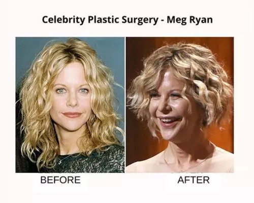 Celebrity-plastic-surgery-meg-ryan