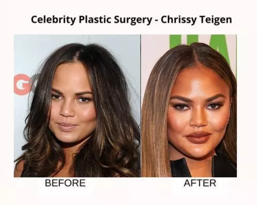 Celebrity-plastic-surgery-chrissy-teigen