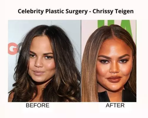 Celebrity Plastic Surgery 51 Before And After Images Fabbon 6810