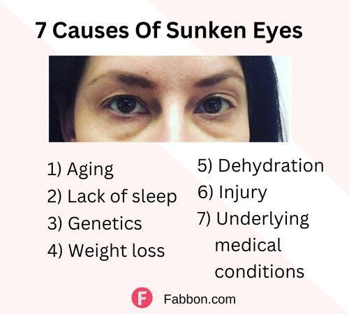 sunken eyes causes