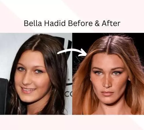 bella-hadid-before-after