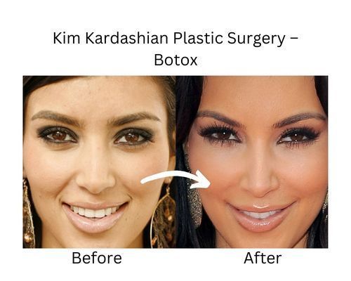 kim kardashian plastic surgery before and after