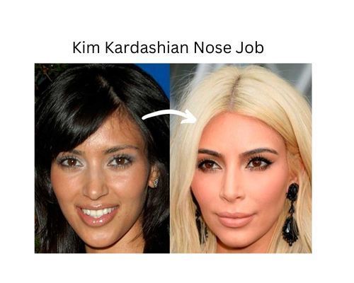 kim-kardashian-nose-job