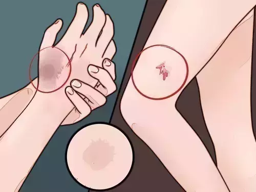 http://www.wikihow.com/images/a/a3/Not-Pick-a-Scab-Step-12.jpg