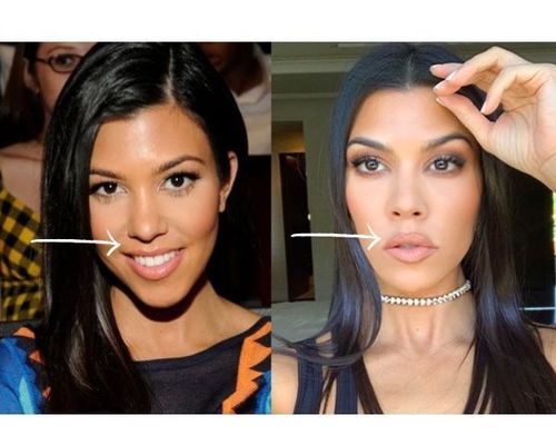 kourtney kardashian nose job before and after