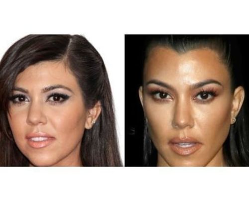 Kourtney Kardashian eyelid surgery