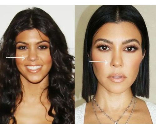 Kourtney Kardashian rhinoplasty